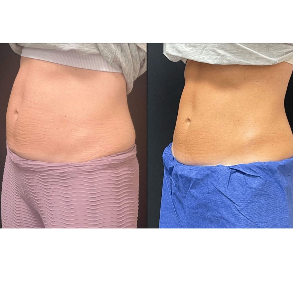 emsculpt neo before and after results 