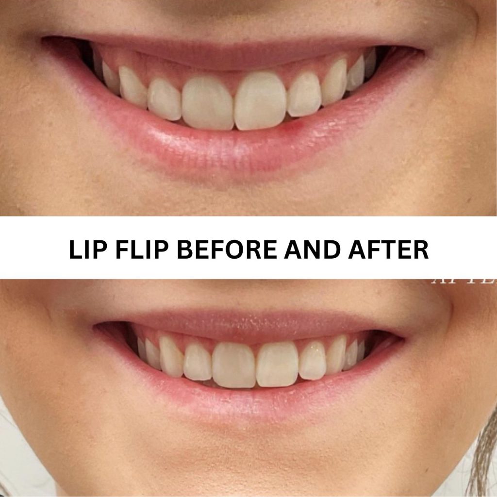  Benefits of Lip Flip