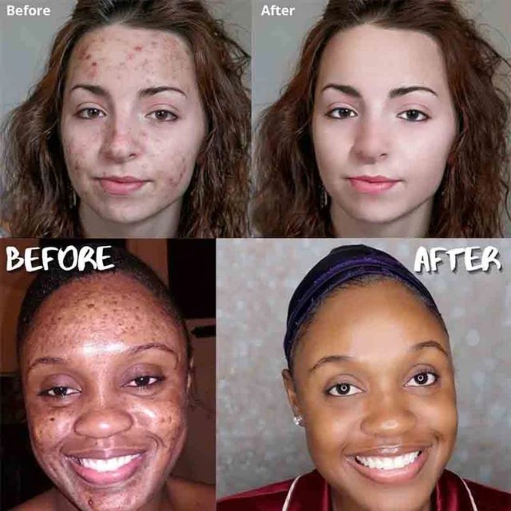 Before and After Results of Kojic Acid Soap