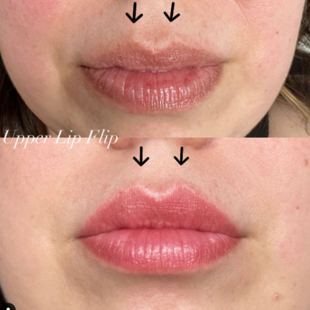 Lip Flip As Non-Surgical Procedure