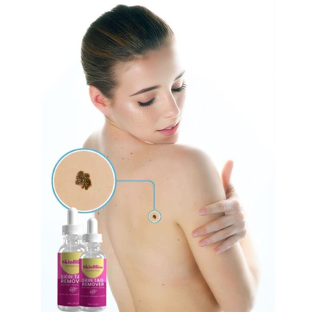 Bliss Skin Tag Remover for Flawless Skin