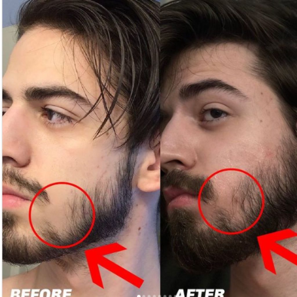 Beard Roller Before and After