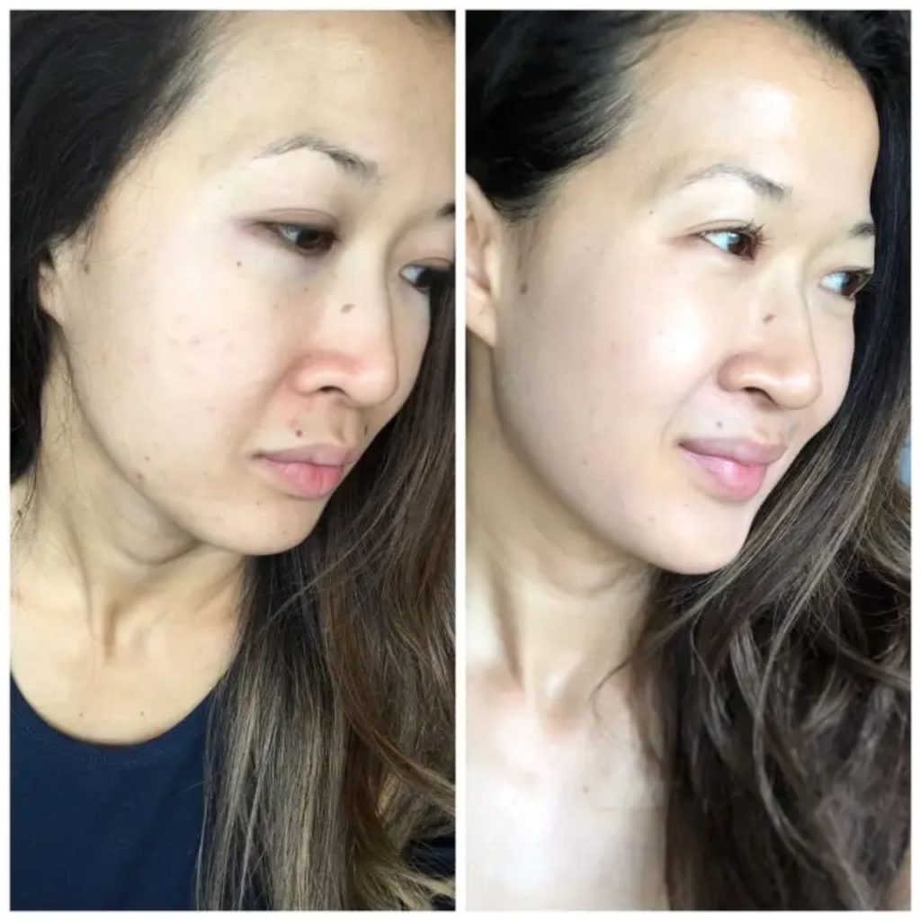 Zo Skin Before and After    Results